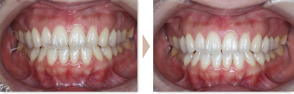 ホワイトニング症例①