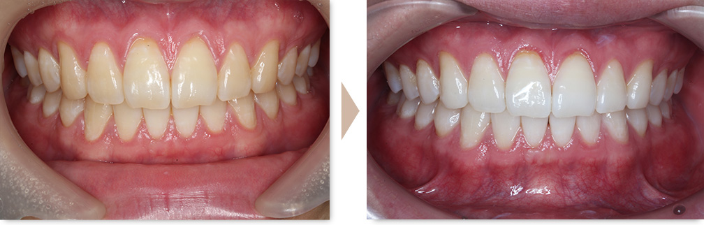ホワイトニング症例②